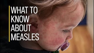 What to know about measles [upl. by Rodnas]