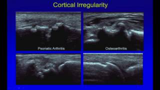 Ultrasound of Arthritis Gout Psoriatic Degenerative Seronegative [upl. by Hadihsar]