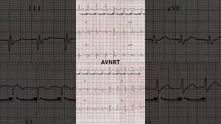 AVNRT ECG Narrow QRS complex [upl. by Namas]