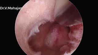 Hysteroscopic Polypectomy Using TrueClear Hysteroscopic Morcellator System [upl. by Gaelan598]