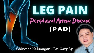 Leg Pain Peripheral Artery Disease PAD  Dr Gary Sy [upl. by Atinrahs]