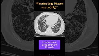 Fibrosing Lung Diseases seen on HRCT Differential Diagnosis UIP NSIP DIP shorts [upl. by Mayworm]