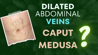 Dilated Veins in the Abdomen  Caput Medusa and Thoracoepigastric veins [upl. by Marina950]