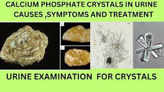 CALCIUM PHOSPHATE CRYSTALS IN URINECAUSES SYMPTOMS TREATMENT OF CALCIUM PHOSPHATE STONES [upl. by Adnesor]