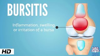 Bursitis Causes Signs and Symptoms Diagnosis and Treatment [upl. by Anauqat445]