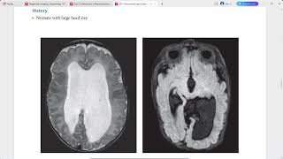 NEURORADIOLOGY EXAM CASES LECTURE [upl. by Zoltai]