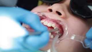 Braces Putting Braces On Bonding Procedure  Aura Orthodontics [upl. by Aticilef]