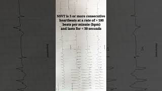 NSVT ECG interpretation made easy  Non Sustained Ventricular Tachycardia shortsfeed shorts ecg [upl. by Ricki826]