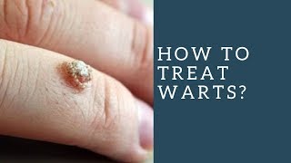 WARTS REMOVAL WITH LASER [upl. by Nimoynib]