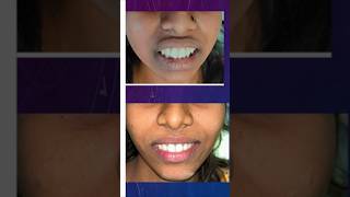 Forwardly Placed Front Teeth Correction with Braces [upl. by Tterab695]