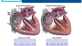 Managing Atrial Fibrillation Heart Forum Webinar  CardioSmart [upl. by Yroj]