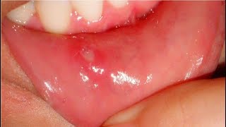 how to get rid of canker sores in minutes [upl. by Annoyed]