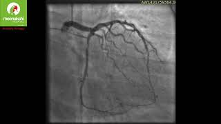 Spontaneous Dissection of Coronary Arteries A Rarity [upl. by Acinoryt]