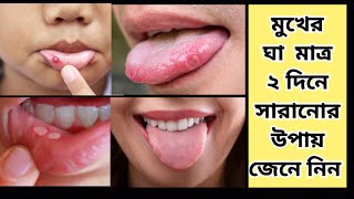 মাত্র ২ দিনে মুখের ঘা সারানোর উপায় জেনে নিন  How to get rid of mouth ulcer in 2 days [upl. by Elsilrac456]