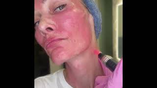 Microneedling Technique  Neck Submentum amp Lower Jawline [upl. by Landy]