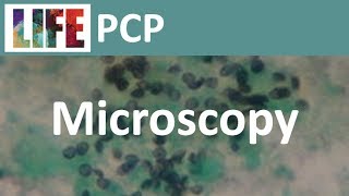 Pneumocystis microscopy [upl. by Nate]