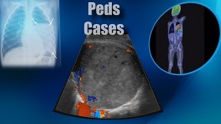 Cases  Chest  Pleuropulmonary Blastoma III [upl. by Anyel]