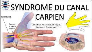 Syndrome du canal carpien Symptomes operation main chirurgie de décompression ou infiltration EMG [upl. by Lazaruk]