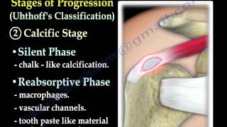 Calcific Tendonitis  Everything You Need To Know  Dr Nabil Ebraheim [upl. by Grega]