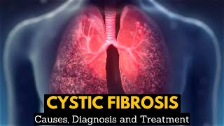 CYSTIC FIBROSIS Causes Signs and Symptoms Diagnosis and Treatment [upl. by Beker733]