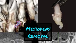 Palatal Mesiodens Removal [upl. by Avle736]