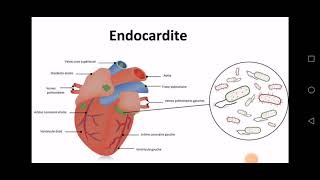 Lendocardite infectieuse [upl. by Olivette]