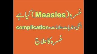 What Is MeaslesKhasraExplainedMeasles Causes SignampSymptomsComplicationTreatment amir Health [upl. by Rosalie744]