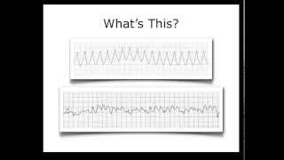 ECG Heart Rhythm Review [upl. by Eissahc]