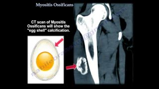 Myositis Ossificans  Everything You Need To Know  Dr Nabil Ebraheim [upl. by Ahsart]