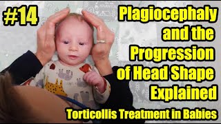 14 Plagiocephaly and the Progression of Head Shape Explained Torticollis Treatment in Babies [upl. by Lyret285]