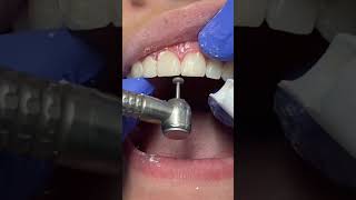 Ortho debonding  identist aligner centre calicut [upl. by Yblocaj]