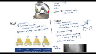 Osteochondritis and Osgood Schlatter for the USMLE [upl. by Aremihc]