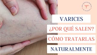 Por qué salen las VARICES y cómo tratarlas de forma natural [upl. by Anerok]