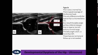 Developmental Dysplasia of the Hip  Ultrasound [upl. by Dniren]