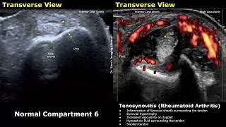 Wrist Hand amp Finger Ultrasound Normal Vs Abnormal Images  Tenosynovitis Rheumatoid Arthritis USG [upl. by Ignacius]