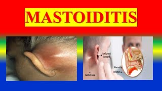 MASTOIDITIS  define  classification  pathophysiology  clinical  diagnostic  management [upl. by Ahsemad]