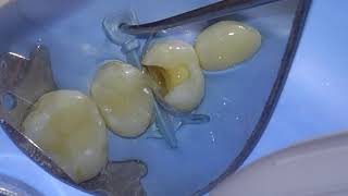 CLASS 2 COMPOSITE RESTORATIONS PERFROMED WITH RUBBER DAM [upl. by Sileas]