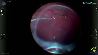 PPV for retinal detachment with large breaks and some previous prophilactic laser treatment [upl. by Tobye]