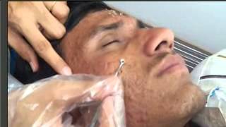 ACNE VULGARIS  Dr Bhutada cosmetology clinic [upl. by Rhetta440]