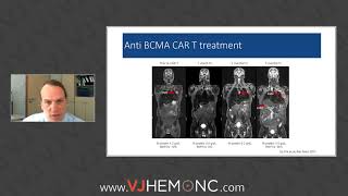 Homozygous BCMA deletion in response to idecel in myeloma patient [upl. by Fergus]