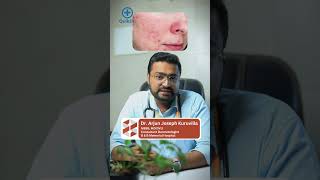 മുഖക്കുരു പാടുകൾ എങ്ങനെ എളുപ്പത്തിൽ മാറ്റാം  Acne Scars Treatment Malayalam [upl. by Oiruam]