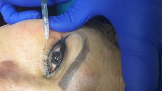 Botox for under eye wrinkles [upl. by Appleton]