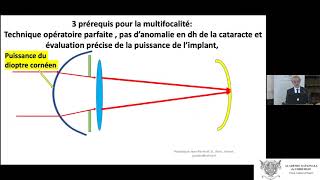 Chirurgie de la cataracte  évolution technologique des implants intraoculaires multifocaux [upl. by Johnny49]