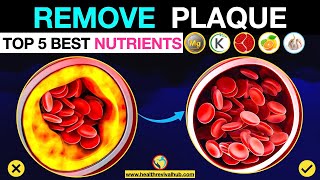 Remove Calcium Plaque from Arteries with THESE Nutrients [upl. by Yvel]