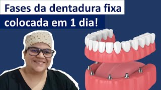 Passoapasso da dentadura fixa em 1 dia Dra Bianca Rosa [upl. by Ury]