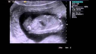 4th month pregnancy  ultrasound [upl. by Ojiram]