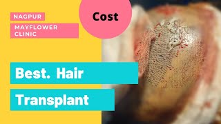 hair transplant cost in Nagpur and review [upl. by Aimat523]