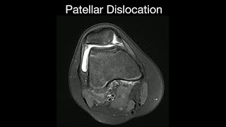 Patellar Dislocation [upl. by Linetta]