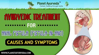 Ayurvedic Treatment for Fistula in Ano  Causes and Symptoms [upl. by Ahsirahc]