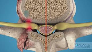 What is Cervical Lateral Stenosis AtlanticSpineCenter [upl. by Alphonsine]